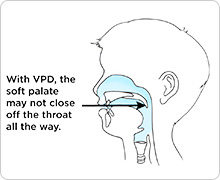 Speech with VPD: An open soft palate lets air flow through the nose and mouth (shown in blue).